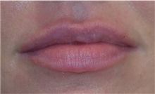 Lip Augmentation / Enhancement After Photo by Richard Reish, MD, FACS; New York, NY - Case 30940