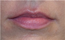 Lip Augmentation / Enhancement Before Photo by Richard Reish, MD, FACS; New York, NY - Case 30940