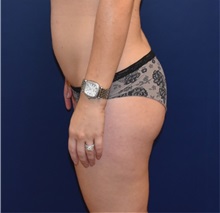 Buttock Lift with Augmentation Before Photo by Richard Reish, MD, FACS; New York, NY - Case 30949