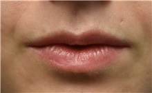Lip Augmentation / Enhancement Before Photo by Richard Reish, MD, FACS; New York, NY - Case 30957