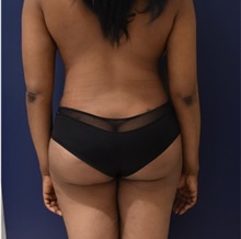 Buttock Lift with Augmentation After Photo by Richard Reish, MD, FACS; New York, NY - Case 30959