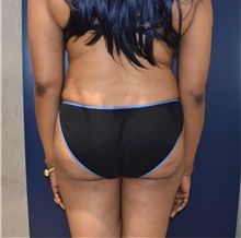 Buttock Lift with Augmentation Before Photo by Richard Reish, MD, FACS; New York, NY - Case 30959