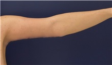 Arm Lift After Photo by Richard Reish, MD, FACS; New York, NY - Case 30961