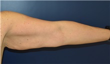 Arm Lift Before Photo by Richard Reish, MD, FACS; New York, NY - Case 30961