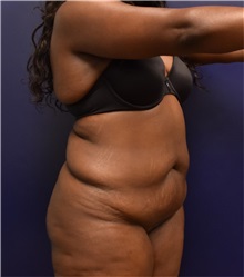 Tummy Tuck Before Photo by Richard Reish, MD, FACS; New York, NY - Case 30965