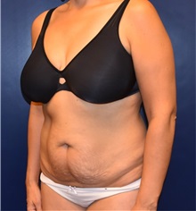 Tummy Tuck Before Photo by Richard Reish, MD, FACS; New York, NY - Case 30966