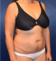 Tummy Tuck Before Photo by Richard Reish, MD, FACS; New York, NY - Case 30966