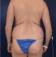 Liposuction Before Photo by Richard Reish, MD, FACS; New York, NY - Case 30970