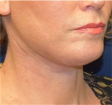 Facelift After Photo by Richard Reish, MD, FACS; New York, NY - Case 30972