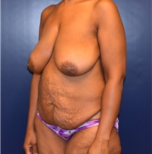 Tummy Tuck Before Photo by Richard Reish, MD, FACS; New York, NY - Case 32659