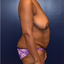 Tummy Tuck Before Photo by Richard Reish, MD, FACS; New York, NY - Case 32659