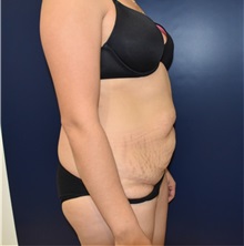 Tummy Tuck Before Photo by Richard Reish, MD, FACS; New York, NY - Case 32662