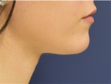 Chin Augmentation After Photo by Richard Reish, MD, FACS; New York, NY - Case 32663