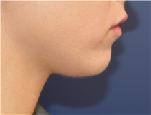 Chin Augmentation Before Photo by Richard Reish, MD, FACS; New York, NY - Case 32663
