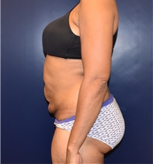 Tummy Tuck Before Photo by Richard Reish, MD, FACS; New York, NY - Case 32664
