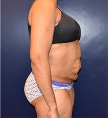 Tummy Tuck Before Photo by Richard Reish, MD, FACS; New York, NY - Case 32664