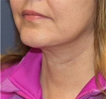 Facelift After Photo by Richard Reish, MD, FACS; New York, NY - Case 32675