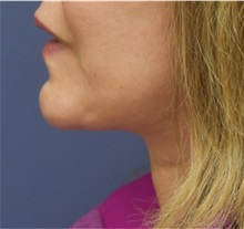 Facelift After Photo by Richard Reish, MD, FACS; New York, NY - Case 32675