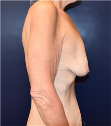 Breast Lift Before Photo by Richard Reish, MD, FACS; New York, NY - Case 32678