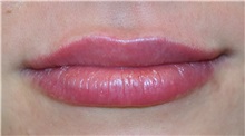 Lip Augmentation / Enhancement After Photo by Richard Reish, MD, FACS; New York, NY - Case 32679
