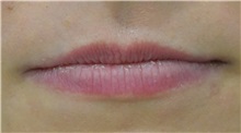 Lip Augmentation / Enhancement Before Photo by Richard Reish, MD, FACS; New York, NY - Case 32679