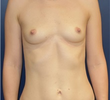 Breast Augmentation Before Photo by Richard Reish, MD, FACS; New York, NY - Case 32685