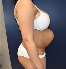 Tummy Tuck Before Photo by Richard Reish, MD, FACS; New York, NY - Case 32686