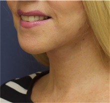 Facelift After Photo by Richard Reish, MD, FACS; New York, NY - Case 32687