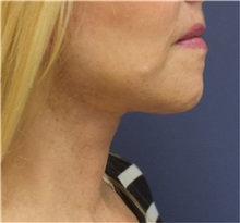 Facelift After Photo by Richard Reish, MD, FACS; New York, NY - Case 32687