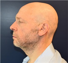 Facelift After Photo by Richard Reish, MD, FACS; New York, NY - Case 32688