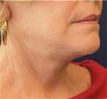 Facelift After Photo by Richard Reish, MD, FACS; New York, NY - Case 32831