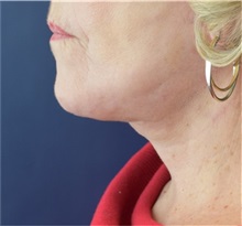 Facelift After Photo by Richard Reish, MD, FACS; New York, NY - Case 32831