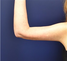 Arm Lift After Photo by Richard Reish, MD, FACS; New York, NY - Case 32832
