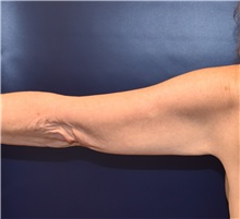 Arm Lift Before Photo by Richard Reish, MD, FACS; New York, NY - Case 32832