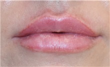 Lip Augmentation / Enhancement After Photo by Richard Reish, MD, FACS; New York, NY - Case 32833