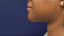 Chin Augmentation After Photo by Richard Reish, MD, FACS; New York, NY - Case 32834