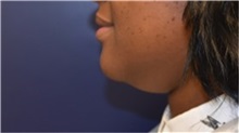 Chin Augmentation Before Photo by Richard Reish, MD, FACS; New York, NY - Case 32834