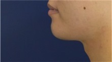 Chin Augmentation After Photo by Richard Reish, MD, FACS; New York, NY - Case 32835