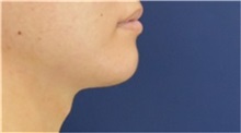 Chin Augmentation After Photo by Richard Reish, MD, FACS; New York, NY - Case 32835
