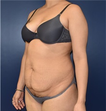 Tummy Tuck Before Photo by Richard Reish, MD, FACS; New York, NY - Case 32836