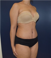 Tummy Tuck After Photo by Richard Reish, MD, FACS; New York, NY - Case 32836