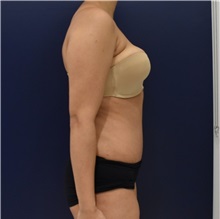 Tummy Tuck After Photo by Richard Reish, MD, FACS; New York, NY - Case 32836