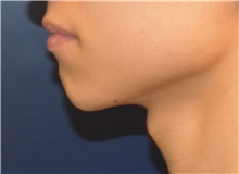 Chin Augmentation Before Photo by Richard Reish, MD, FACS; New York, NY - Case 32838