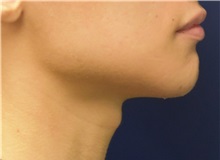 Chin Augmentation After Photo by Richard Reish, MD, FACS; New York, NY - Case 32838
