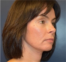 Facelift After Photo by Richard Reish, MD, FACS; New York, NY - Case 32839