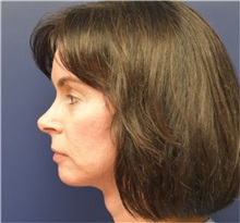 Facelift After Photo by Richard Reish, MD, FACS; New York, NY - Case 32839