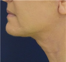 Facelift After Photo by Richard Reish, MD, FACS; New York, NY - Case 32842