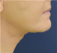 Facelift After Photo by Richard Reish, MD, FACS; New York, NY - Case 32842
