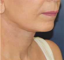 Facelift After Photo by Richard Reish, MD, FACS; New York, NY - Case 32843