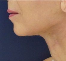 Facelift After Photo by Richard Reish, MD, FACS; New York, NY - Case 32843